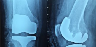 Surface treatment to reduce biomaterial implant rejection
