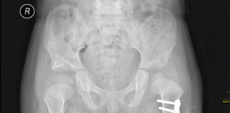 Cross-linked polyethylene hip implants lower rate of repeat surgery