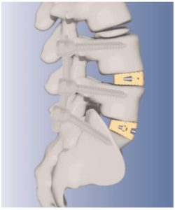 Solvay’s Zeniva® PEEK Enables Advanced Spinal Cage from Japan